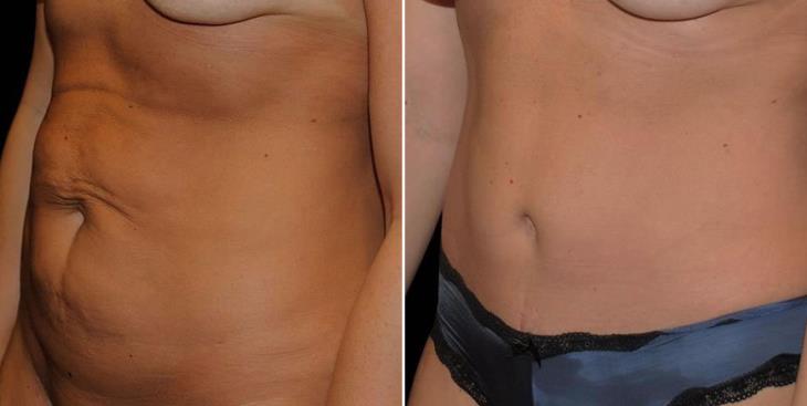 Before & After Georgia Abdominoplasty Side View