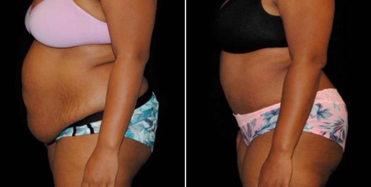 Georgia Abdominoplasty Before & After Left Side