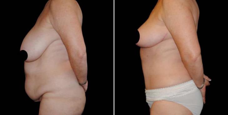 Results Of Georgia Abdominoplasty Side View