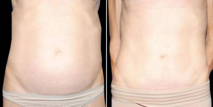 Before & After Mini Tummy Tuck