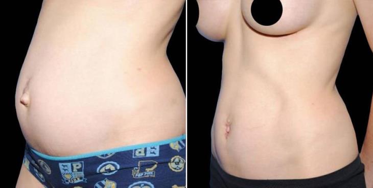 Mini Tummy Tuck Before & After
