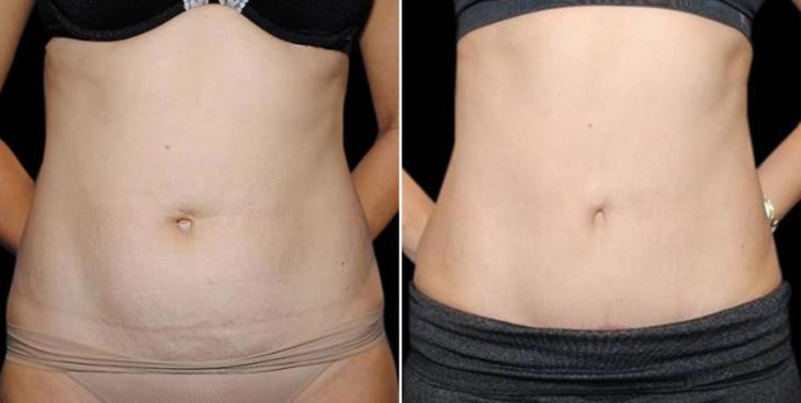 Mini Tummy Tuck Results Atlanta