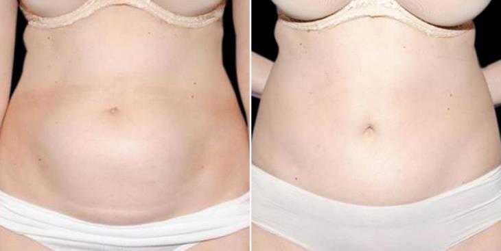 Atlanta Mini Tummy Tuck Results