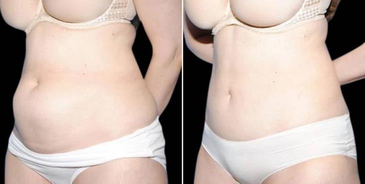 Atlanta Mini Tummy Tuck Results Side View