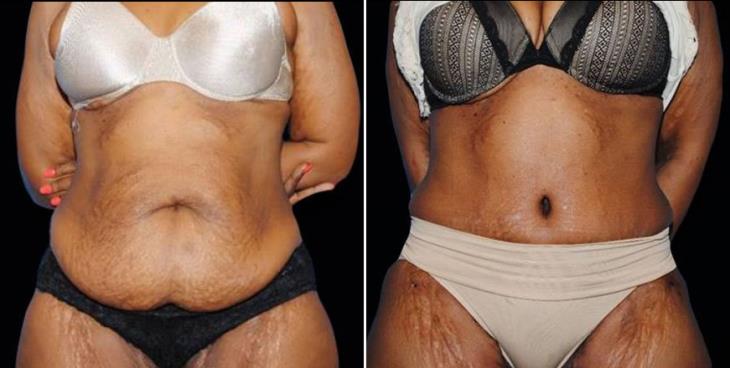 Before & After Body Lift Atlanta