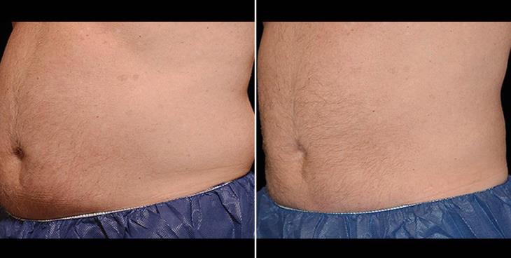 Atlanta CoolSculpting Results