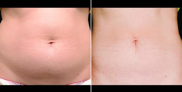 CoolSculpting Results