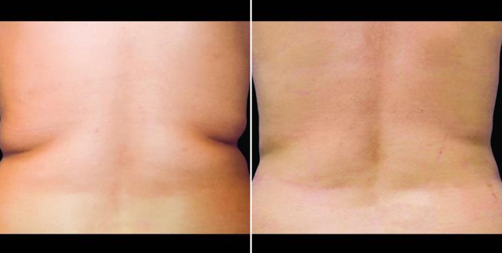 Before & After CoolSculpting