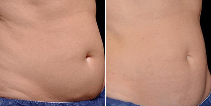 CoolSculpting Before & After