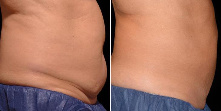 CoolSculpting Results Atlanta