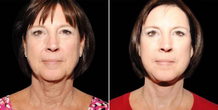 Atlanta Facelift Results