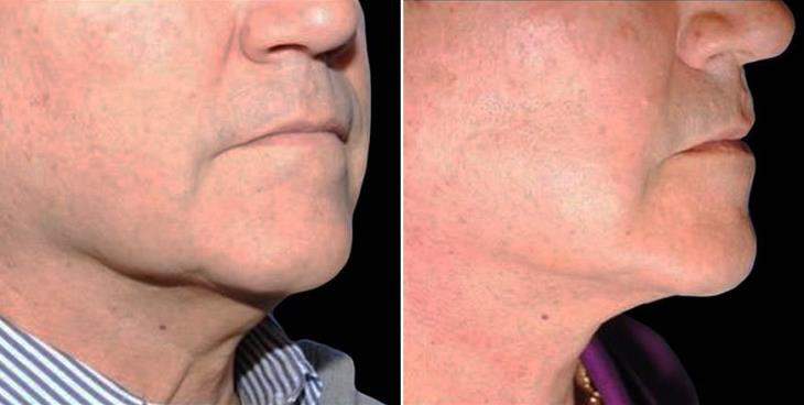 Facelift Results Atlanta