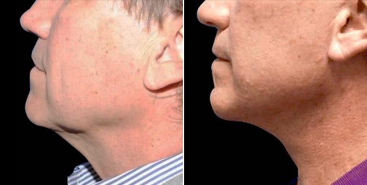 Facelift Results Atlanta