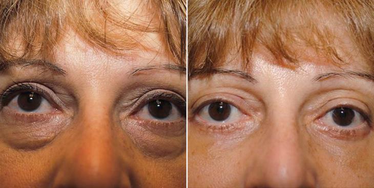 Eyelid Surgery Results Atlanta