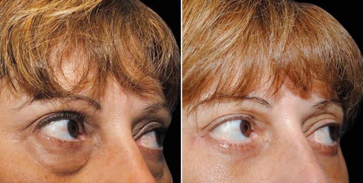 Eyelid Surgery Results Atlanta Side View