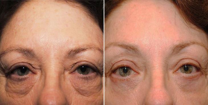 Atlanta Eyelid Surgery Results