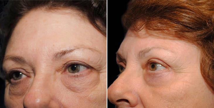 Atlanta Eyelid Surgery Results Side View