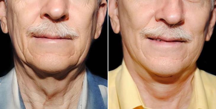 Atlanta Neck Lift Results