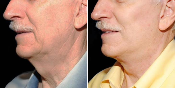 Atlanta Neck Lift Results Side View