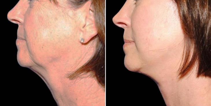 Before & After Neck Lift Side View