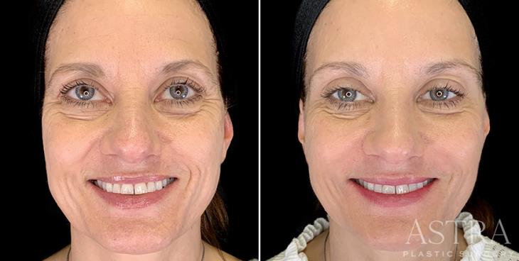 Cosmetic Fillers Before And After