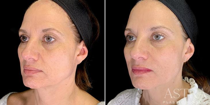Before And After Cosmetic Fillers