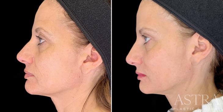 Cosmetic Fillers Before And After Side View