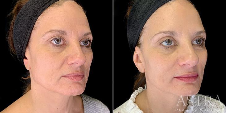 Cosmetic Fillers Before And After ¾ View