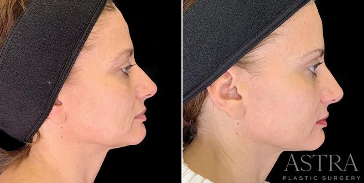 Side View Cosmetic Fillers Before And After