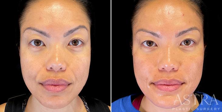 Before & After Cosmetic Fillers