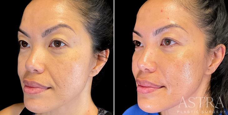 Before & After Cosmetic Fillers ¾ View