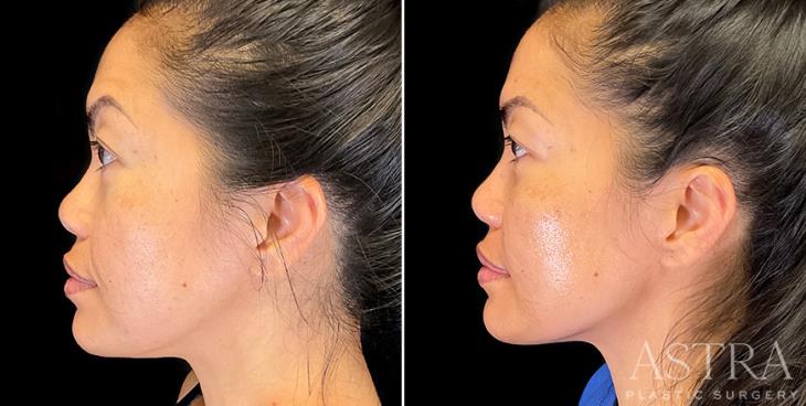 Before & After Cosmetic Fillers Side View