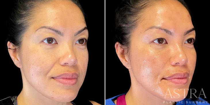 ¾ View Before & After Cosmetic Fillers