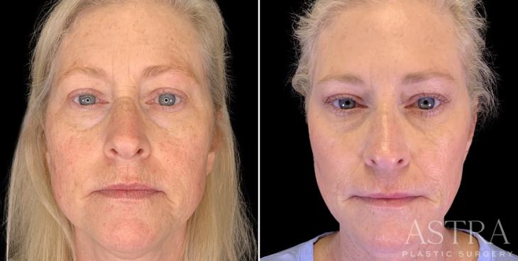 Before & After Cosmetic Fillers Atlanta
