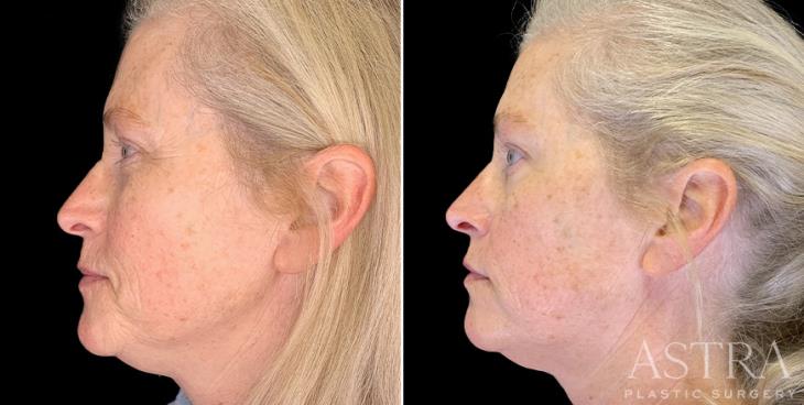 Before & After Cosmetic Fillers Atlanta Side View