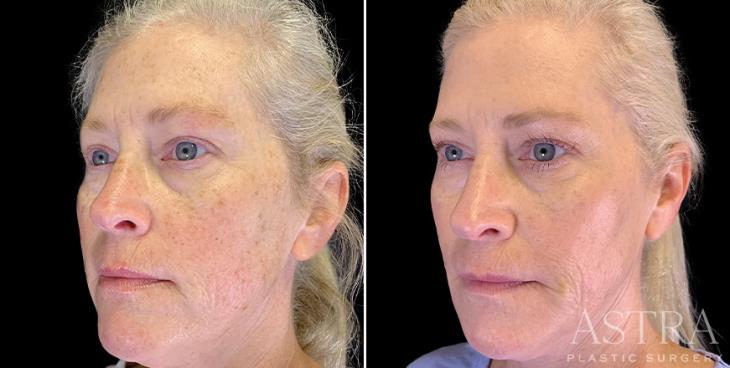 Before & After Cosmetic Fillers Atlanta ¾ View