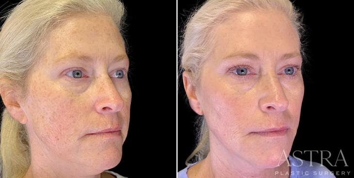 ¾ View Before & After Cosmetic Fillers Atlanta