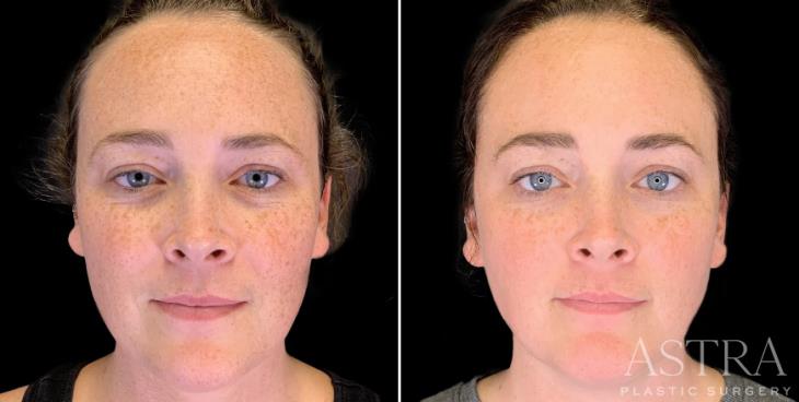 IPL Photofacial Results