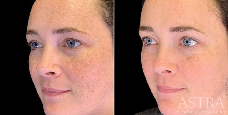 Before And After IPL Photofacial