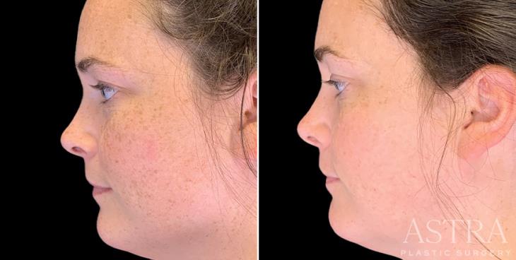 Results Of IPL Photofacial