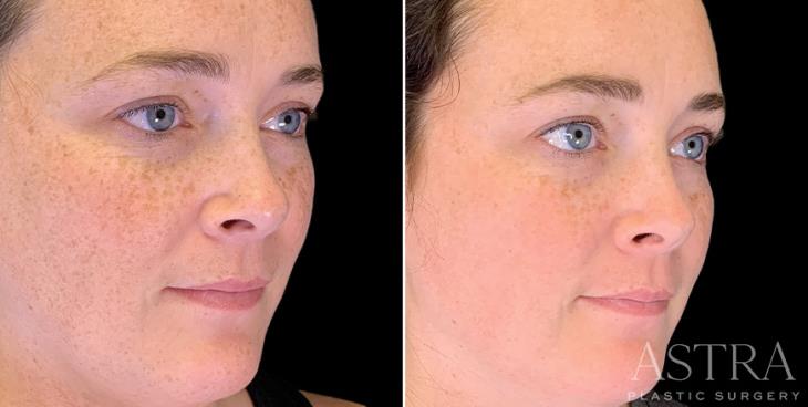 IPL Photofacial Before And After