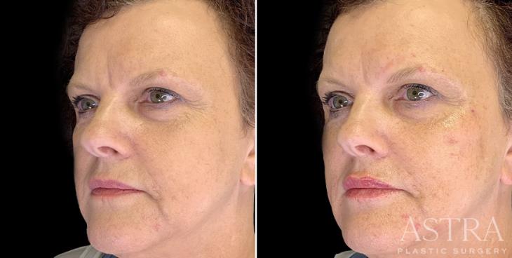 Cosmetic Fillers Atlanta Before & After ¾ View