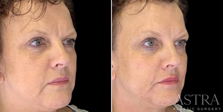 ¾ View Cosmetic Fillers Atlanta Before & After