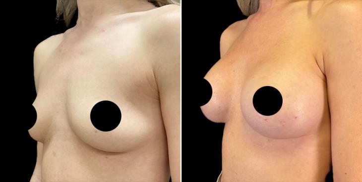 Breast Augmentation Alpharetta ¾ Left View