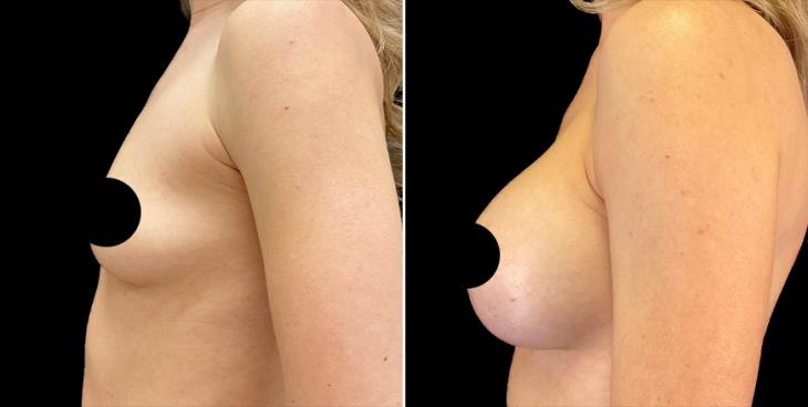 Breast Augmentation Alpharetta Left Side View