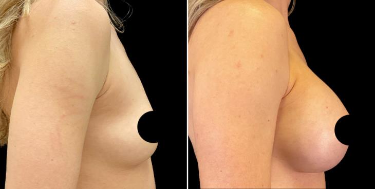 Breast Augmentation Alpharetta Right Side View
