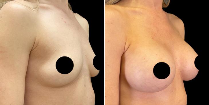 Breast Augmentation Alpharetta ¾ Right View