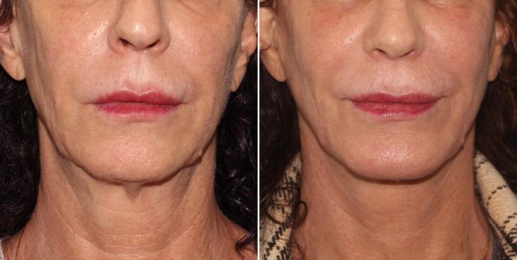 Results Of Neck Lift Atlanta GA
