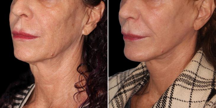 Atlanta Neck Lift Surgery Results ¾ Left View