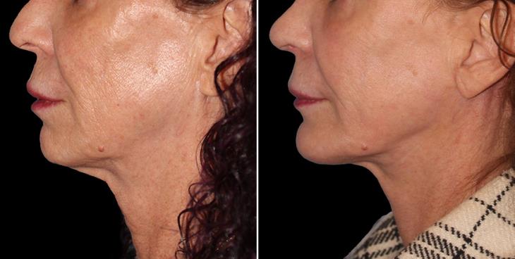 Atlanta Neck Lift Surgery Results Left Side View